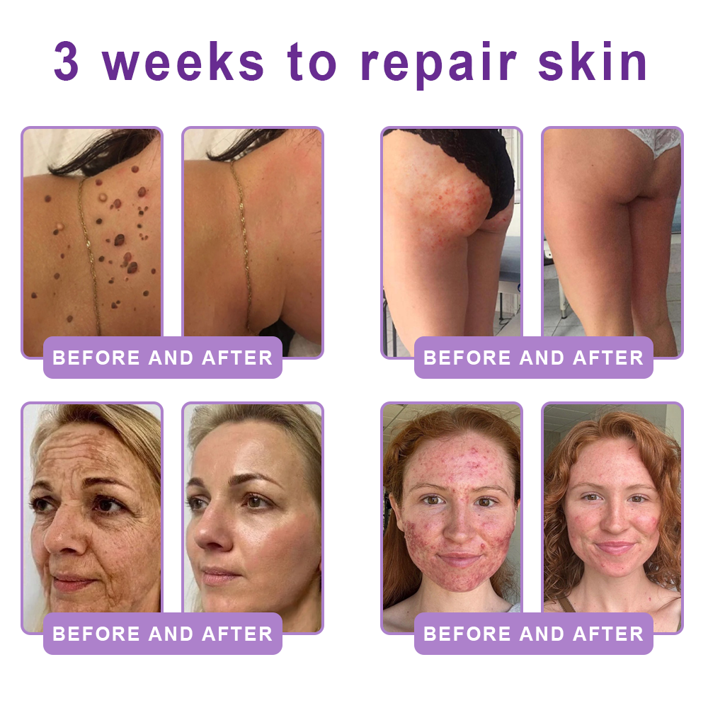 𝐋𝐮𝐦𝐨𝐫𝐢𝐞® PDRN🦘 Multi-Peptide Massaging Body Roller Cream- Anti-aging, Hydrating, Skin Firming & Lifting, Skin Repair, Even Tone, Acne and Dark Spot Treatment, Wart and Mole Removal, and Psoriasis Relief.