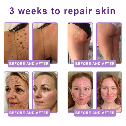 𝐋𝐮𝐦𝐨𝐫𝐢𝐞® PDRN🦘 Multi-Peptide Massaging Body Roller Cream- Anti-aging, Hydrating, Skin Firming & Lifting, Skin Repair, Even Tone, Acne and Dark Spot Treatment, Wart and Mole Removal, and Psoriasis Relief.