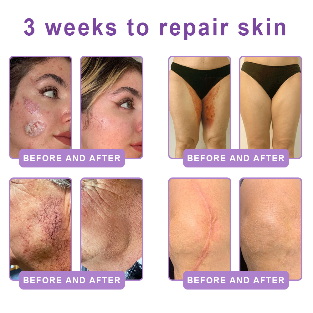 𝐋𝐮𝐦𝐨𝐫𝐢𝐞® PDRN🦘 Multi-Peptide Massaging Body Roller Cream- Anti-aging, Hydrating, Skin Firming & Lifting, Skin Repair, Even Tone, Acne and Dark Spot Treatment, Wart and Mole Removal, and Psoriasis Relief.