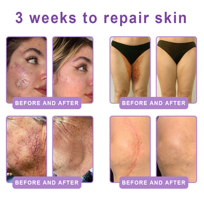 𝐋𝐮𝐦𝐨𝐫𝐢𝐞® PDRN🦘 Multi-Peptide Massaging Body Roller Cream- Anti-aging, Hydrating, Skin Firming & Lifting, Skin Repair, Even Tone, Acne and Dark Spot Treatment, Wart and Mole Removal, and Psoriasis Relief.