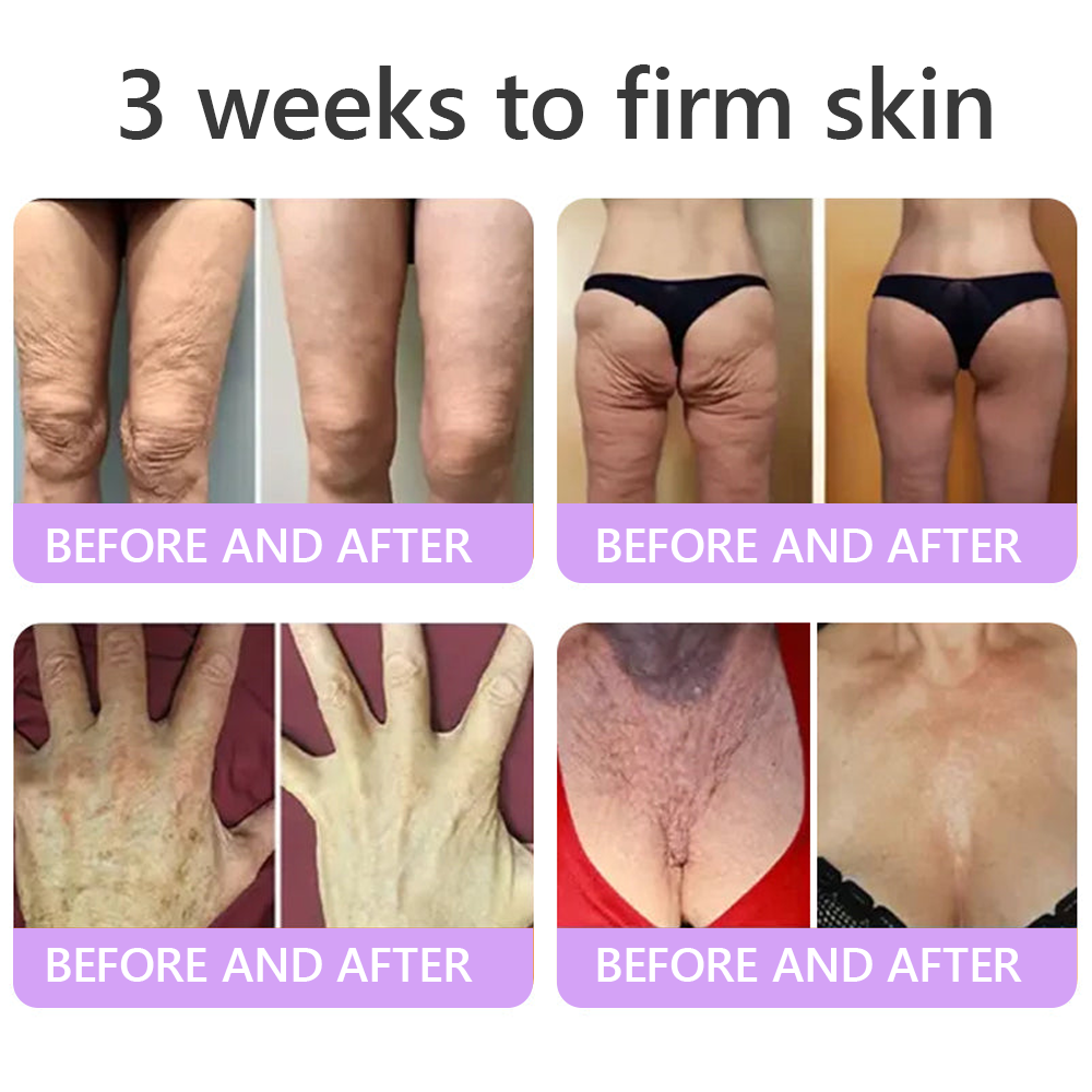 𝐋𝐮𝐦𝐨𝐫𝐢𝐞® PDRN🦘 Multi-Peptide Massaging Body Roller Cream- Anti-aging, Hydrating, Skin Firming & Lifting, Skin Repair, Even Tone, Acne and Dark Spot Treatment, Wart and Mole Removal, and Psoriasis Relief.